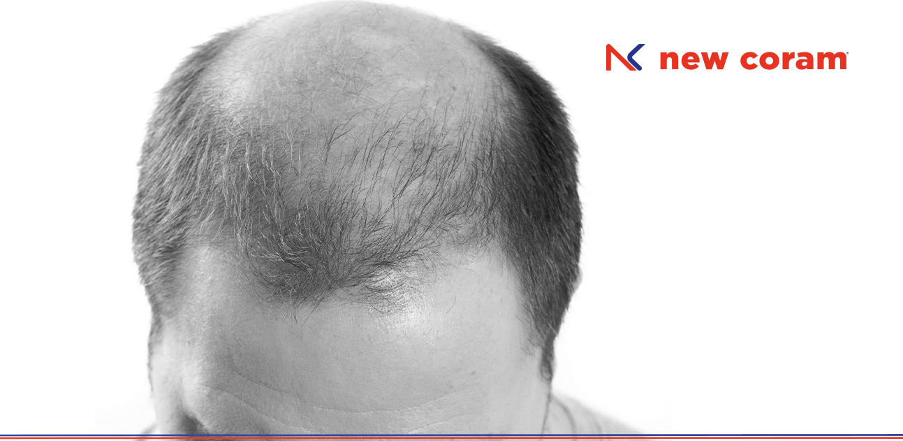 I fattori di crescita piastrinici per il trattamento dell'alopecia